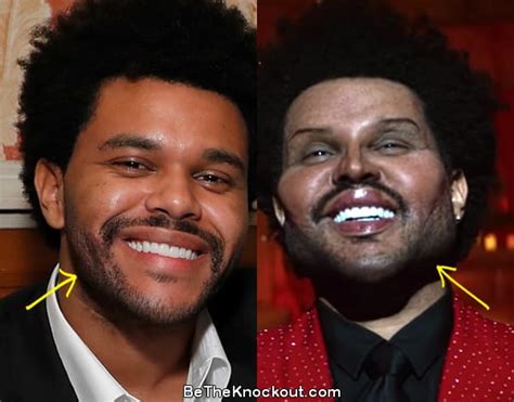 did the weeknd get plastic surgery